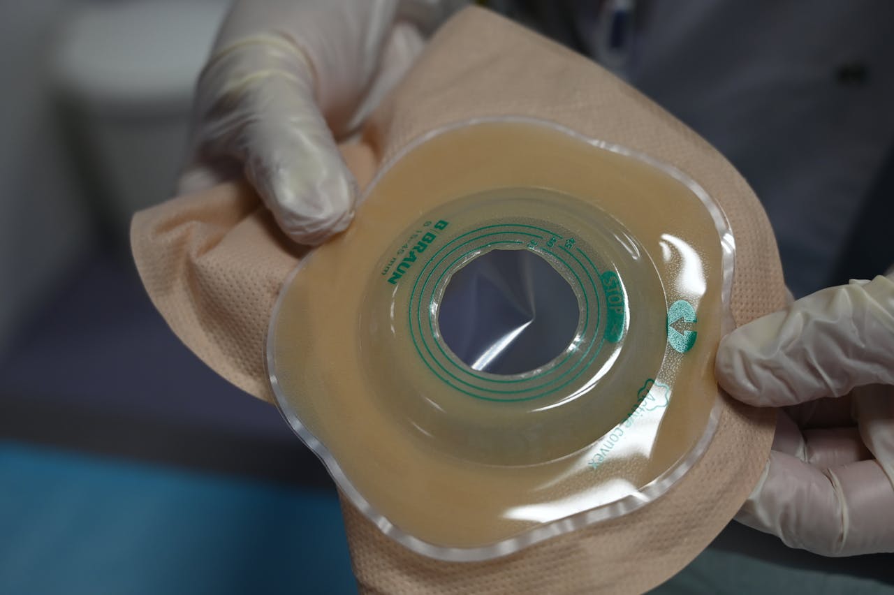 Close-up of a healthcare professional holding an ostomy bag with gloves in a medical setting.